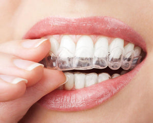 Dental Mouthguard Teeth Whitening Trays Bleaching Tooth Whitener Mouth Guard Care Oral Hygiene kit - jnpworldwide